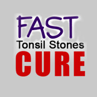 Fast Tonsil Stones Cure